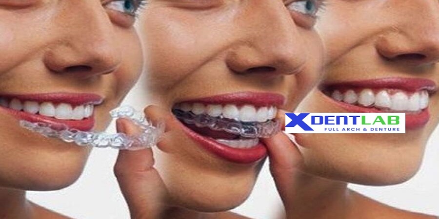 introduce Worldwide clear aligner contract production